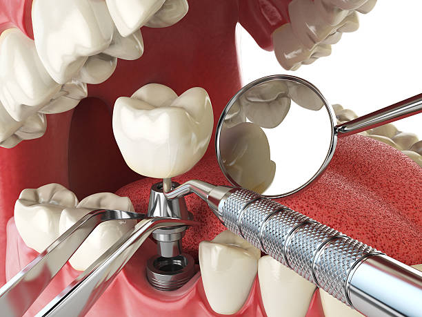 Best Emergency Dentist for Lost Fillings or Crowns in Dallesport, WA